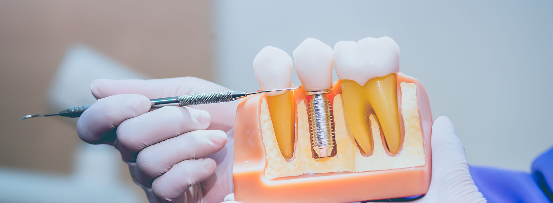 The image shows a close-up of a dental device with a tooth being worked on, with a person s hand holding a tool near it, set against a blurred background that appears to be a medical setting.