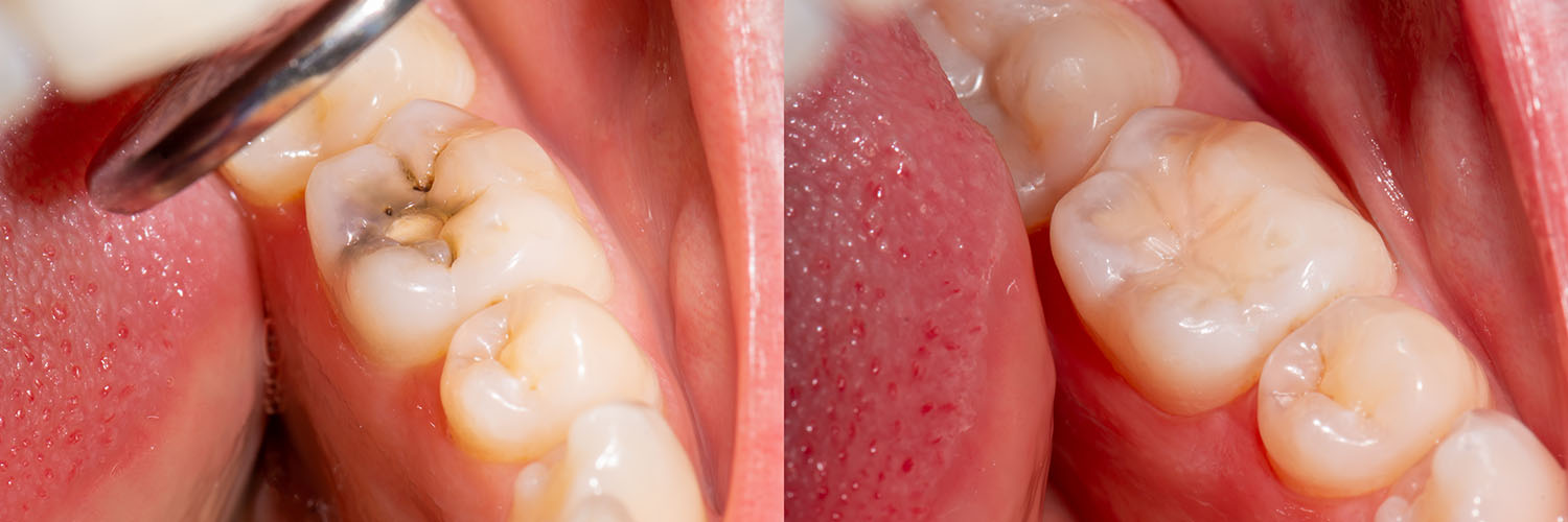 The image shows a close-up view of a mouth with multiple teeth, some of which appear damaged, set against a backdrop that seems to be a medical or dental setting.