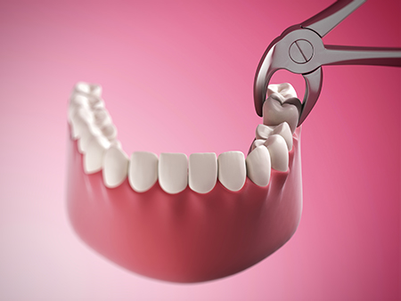 The image displays a close-up of a pink dental implant with teeth being attached using a pair of scissors, highlighting the precision and care involved in dental implant procedures.